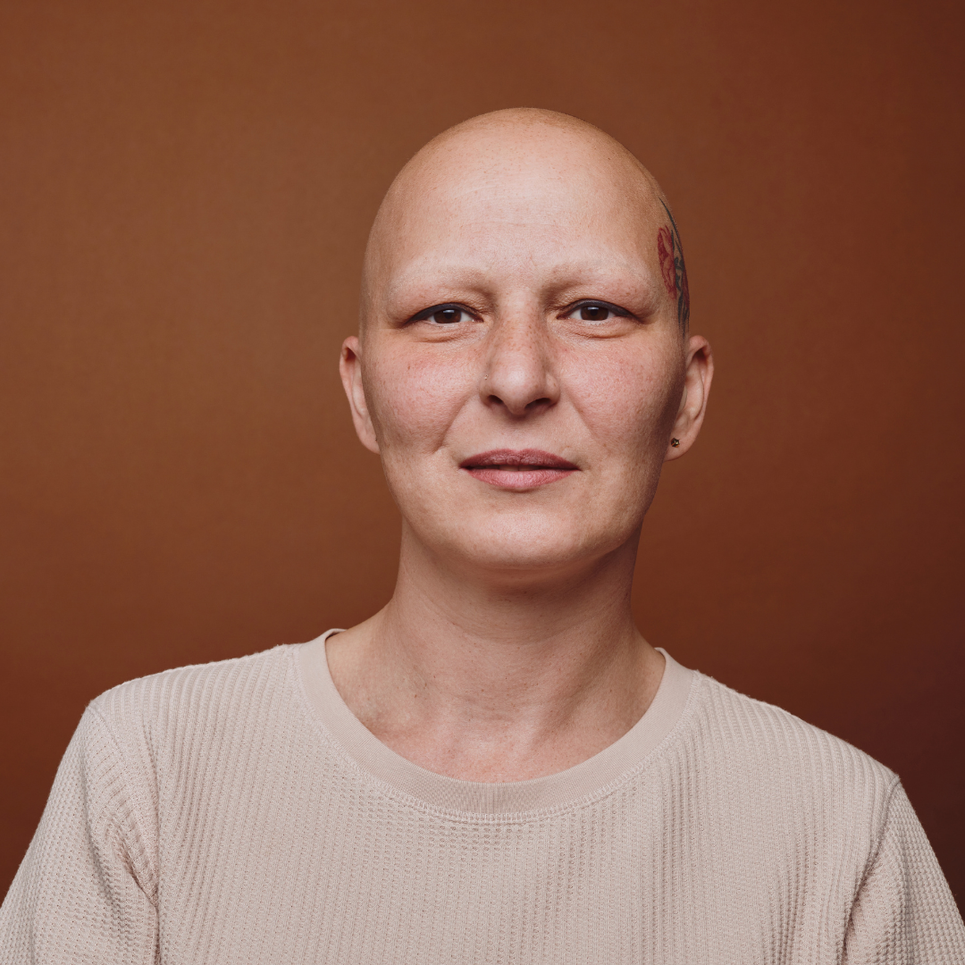 What is Alopecia?