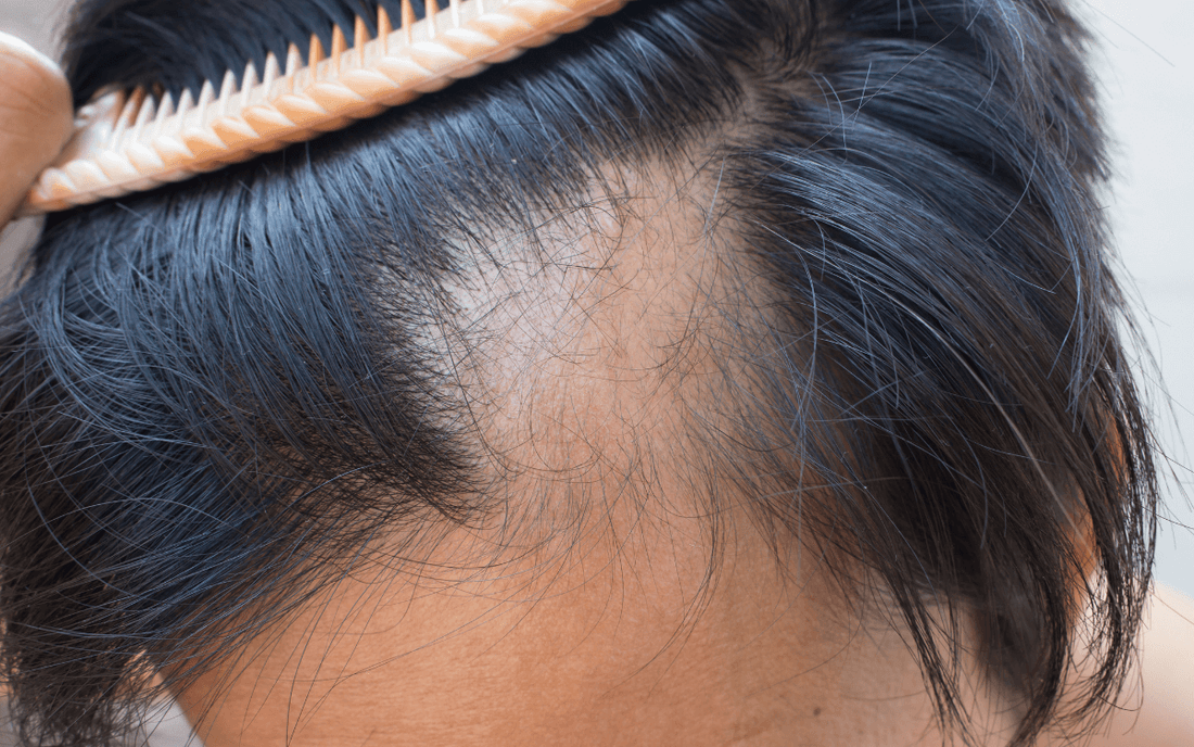 What is Alopecia - A Basic Overview